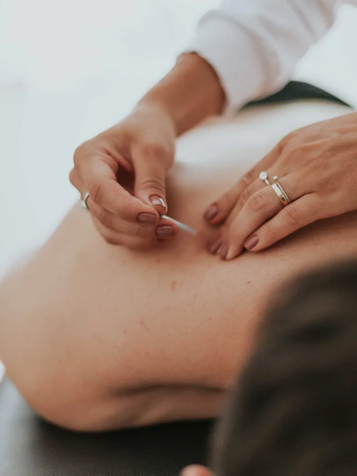 Aplicação de agulha de acupuntura nas costas de uma paciente